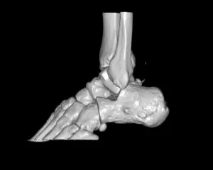 足関節・側面